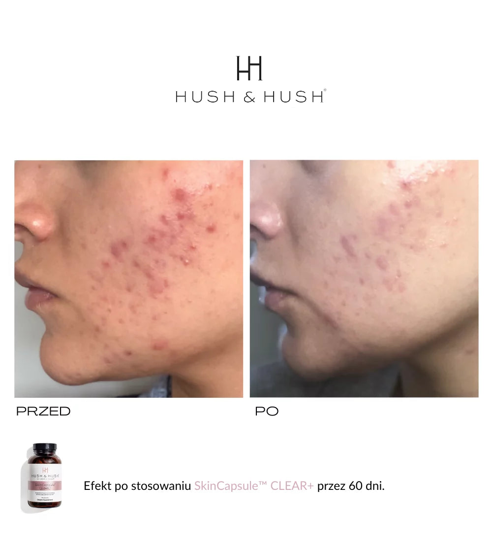 HUSH & HUSH - SkinCapsule CLEAR+ Suplement dla skóry trądzikowej 60 kap.